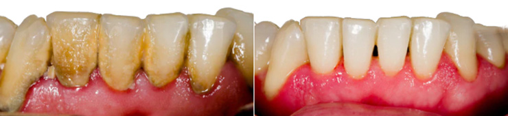 Teeth with tartar vs clean teeth comparison
